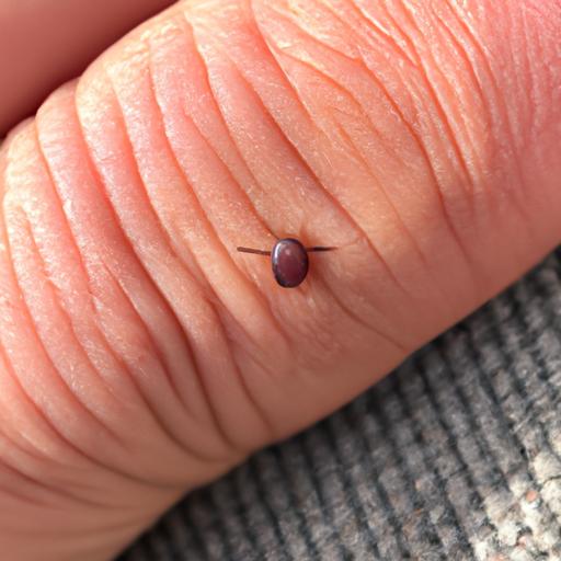 A tick transmitting the bacteria that causes Lyme disease through a bite on human skin